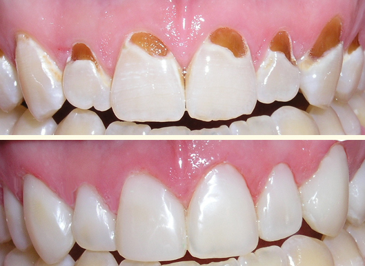 composite bonding example 1